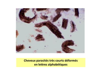 Cheveux parasités très courts déformés
en lettres alphabétiques
 