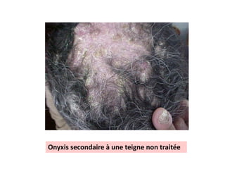 O
Onyxis secondaire à une teigne non traitée
 