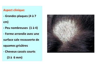 Aspect clinique:
- Grandes plaques (4 à 7
cm)
- Peu nombreuses (1 à 4)
- Forme arrondie avec une
surface sale recouverte de
squames grisâtres
- Cheveux cassés courts
(3 à 6 mm)
 