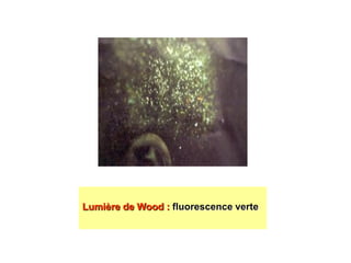 .
Lumière de Wood : fluorescence verte
 