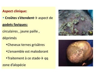 Aspect clinique:
 Croûtes s’étendent→ aspect de
godets faviques:
circulaires , jaune paille ,
déprimés
Cheveux ternes grisâtres
L’ensemble est malodorant
Traitement à ce stade→ qq
zone d’alopécie
 