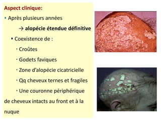 Aspect clinique:
 Après plusieurs années
→ alopécie étendue définitive
 Coexistence de :
 Croûtes
 Godets faviques
 Zone d’alopécie cicatricielle
 Qq cheveux ternes et fragiles
 Une couronne périphérique
de cheveux intacts au front et à la
nuque
 