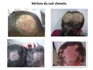 Kérions du cuir chevelu
 