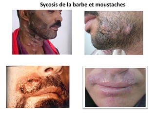 Sycosis de la barbe et moustaches
 