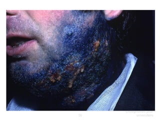 58
Dermatophytes -
Enseignement post-
universitaire
 