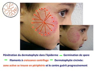 Pénétration du dermatophyte dans l’épiderme Germination de spore
filaments à croissance centrifuge Dermatophytie circinée:
zone active se trouve en périphérie et le centre guérit progressivement
 
