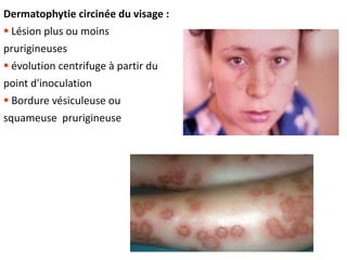 Dermatophytie circinée du visage :
 Lésion plus ou moins
prurigineuses
 évolution centrifuge à partir du
point d'inoculation
 Bordure vésiculeuse ou
squameuse prurigineuse
 