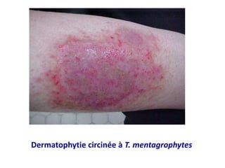 Dermatophytie circinée à T. mentagrophytes
 