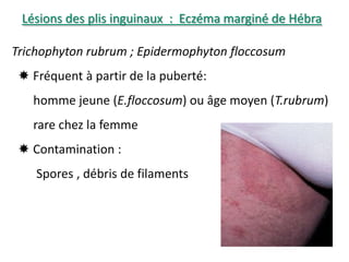 Lésions des plis inguinaux : Eczéma marginé de Hébra
Trichophyton rubrum ; Epidermophyton floccosum
 Fréquent à partir de la puberté:
homme jeune (E.floccosum) ou âge moyen (T.rubrum)
rare chez la femme
 Contamination :
Spores , débris de filaments
 