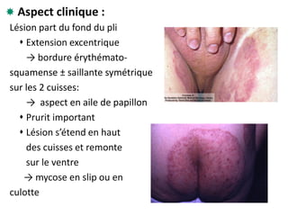  Aspect clinique :
Lésion part du fond du pli
 Extension excentrique
→ bordure érythémato-
squamense ± saillante symétrique
sur les 2 cuisses:
→ aspect en aile de papillon
 Prurit important
 Lésion s’étend en haut
des cuisses et remonte
sur le ventre
→ mycose en slip ou en
culotte
 