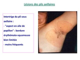 Intertrigo du pli sous
axillaire :
- "aspect en aile de
papillon" : bordure
érythémato-squameuse
bien limitée
- moins fréquents
Lésions des plis axillaires
 
