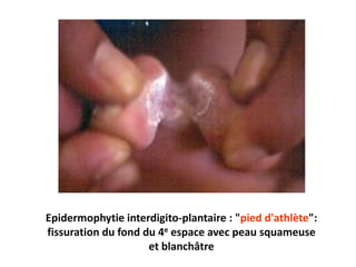 Epidermophytie interdigito-plantaire : "pied d'athlète":
fissuration du fond du 4e espace avec peau squameuse
et blanchâtre
 