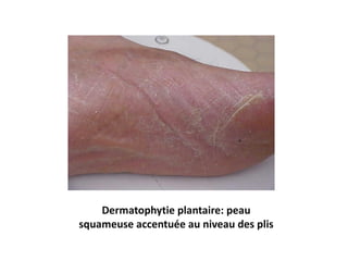 Dermatophytie plantaire: peau
squameuse accentuée au niveau des plis
 