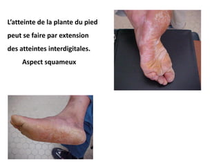L’atteinte de la plante du pied
peut se faire par extension
des atteintes interdigitales.
Aspect squameux
 