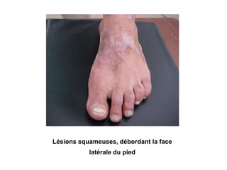 Lésions squameuses, débordant la face
latérale du pied
 