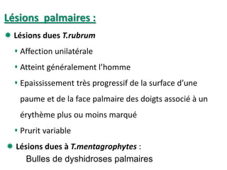 Lésions palmaires :
 Lésions dues T.rubrum :
 Affection unilatérale
 Atteint généralement l’homme d’âge moyen
 Epaississement très progressif de la surface d’une
paume et de la face palmaire des doigts associé à un
érythème plus ou moins marqué
 Prurit variable
 Lésions dues à T.mentagrophytes :
Bulles de dyshidroses palmaires
 