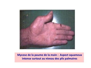 Mycose de la paume de la main : Aspect squameux
intense surtout au niveau des plis palmaires
 