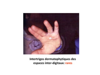 Intertrigos dermatophytiques des
espaces inter-digitaux: rares
 