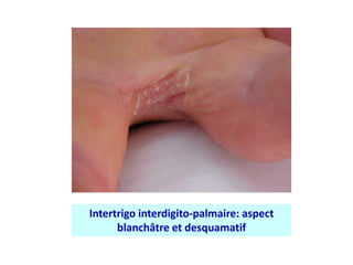 Intertrigo interdigito-palmaire: aspect
blanchâtre et desquamatif
 