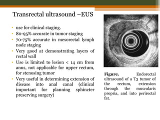 Transrectal ultrasound –EUS
• use for clinical staging.
• 80-95% accurate in tumor staging
• 70-75% accurate in mesorectal lymph
node staging
• Very good at demonstrating layers of
rectal wall
• Use is limited to lesion < 14 cm from
anus, not applicable for upper rectum,
for stenosing tumor
• Very useful in determining extension of
disease into anal canal (clinical
important for planning sphincter
preserving surgery)
Figure. Endorectal
ultrasound of a T3 tumor of
the rectum, extension
through the muscularis
propria, and into perirectal
fat.
 