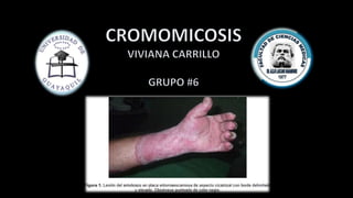 Cromomicosis