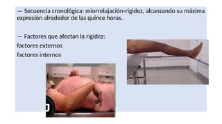 — Secuencia cronológica: miorrelajación-rigidez, alcanzando su máxima
expresión alrededor de las quince horas.
— Factores que afectan la rigidez:
factores externos
factores internos
 
