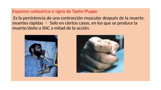 Espasmo cadavérico o signo de Taylor/Puppe
Es la persistencia de una contracción muscular después de la muerte.
muertes rápidas  Solo en ciertos casos, en los que se produce la
muerte/daño a SNC a mitad de la acción.
 