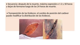 • Secuencia: después de la muerte, máxima expresión e 1 2 y 18 horas
y dejan de formarse luego de las 24 horas de muerte.
• Transposición de las livideces: el cambio de posición del cadáver
puede modificar la distribución de las livideces.
 