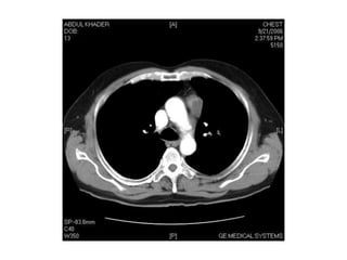 CT IN MEDIASTINUM.ppt