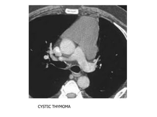 CYSTIC THYMOMA
 