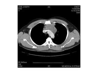 CT IN MEDIASTINUM.ppt