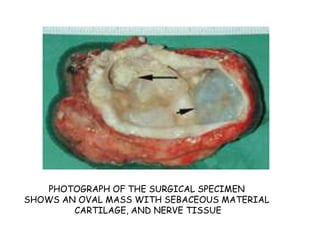 PHOTOGRAPH OF THE SURGICAL SPECIMEN
SHOWS AN OVAL MASS WITH SEBACEOUS MATERIAL
CARTILAGE, AND NERVE TISSUE
 