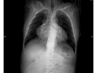CT IN MEDIASTINUM.ppt