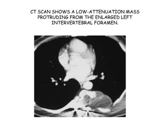 CT SCAN SHOWS A LOW-ATTENUATION MASS
PROTRUDING FROM THE ENLARGED LEFT
INTERVERTEBRAL FORAMEN.
 