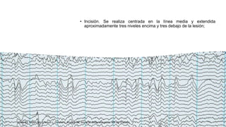• Incisión. Se realiza centrada en la línea media y extendida
aproximadamente tres niveles encima y tres debajo de la lesión;
Miller RD, Cohen NH, Eriksson L, Fleisher L, Kronish JW, Young W. Miller Anestesia. 8th ed: Elsevier;
 