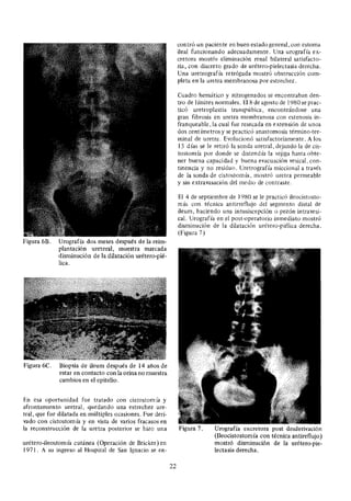 Figura 6B. Urografía dos meses después de la reim-
plantación ureteral, muestra marcada
disminución de la dilatación urétero-pié-
lica.
Figura 6C. Biopsia de ileum después de 14 años de
estar en contacto con la orina no muestra
cambios en el epitelio.
En esa oportunidad fue tratado con cistostom ía y
afrontamiento uretral, quedando una estrechez ure-
tral, que fue dilatada en múltiples ocasiones. Fue deri-
vado con cistostomía y en vista de varios fracasos en
la reconstrucción de la uretra posterior se hizo una
urétero-ileostomía cutánea (Operación de Bricker) en
1971. A su ingreso al Hospital de San Ignacio se en-
contró un paciente en buen estado general, con estoma
ileal funcionando adecuadamente. Una urografía ex-
cretora mostio eliminación renal bilateral satisfacto-
ria, con discreto grado de urétero-pielectasia derecha.
Una uretrografía retrógada mostró obstrucción com-
pleta en la uretra membranosa por estrechez.
Cuadro hemático y nitrogenados se encontraban den-
tro de límites normales. El8 de agosto de 1980 se prac-
ticó uretroplastia transpúbica, encontrándose una
gran fibrosis en uretra membranosa con estenosis in-
franqueable, la cual fue resecada en extensión de unos
dos cent ímetros y se practicó anastomosis término-ter-
minal de uretra. Evolucionó satisfactoriamente. A los
15 días se le retiró la sonda uretral, dejando la de cis-
tostomía por donde se distendía la vejiga hasta obte-
ner buena capacidad y buena evacuación vesical, con-
tinencia y no residuo. Uretrografía miccional a través
de la sonda de cistostomía, mostró uretra permeable
y sin extravasación del medio de contraste.
El 4 de septiembre de 1980 se le practicó ileocistosto-
mía con técnica antirreflujo del segmento distal de
ileum, haciendo una intusiscepción o pezón intravesi-
cal. Urograf ía en el post-operatorio inmediato mostró
disminución de la dilatación urétero-piélica derecha.
(Figura 7)
Figura 7. Urografía excretora post desderivación
(Ileocistostomía con técnica antireflujo)
mostró disminución de la urétero-pie-
lectasia derecha.
22
 