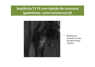 Seqüência T1 FS com injeção de contraste
(gadolíneo), corte transversal (d)
• d) Realce ao
contraste na área
de edema ósseo
medular.
 