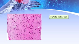 White matter tear
 