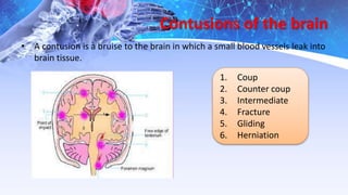 Contusions of the brain
• A contusion is a bruise to the brain in which a small blood vessels leak into
brain tissue.
1. Coup
2. Counter coup
3. Intermediate
4. Fracture
5. Gliding
6. Herniation
 