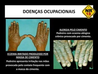DOENÇAS OCUPACIONAIS
ECZEMA IRRITADO PRODUZIDO POR
MASSA DE CIMENTO
Pedreiro apresenta irritação nas mãos
provocada pelo contato frequente com
a massa do cimento.
ALERGIA PELO CIMENTO
Pedreiro com eczema alérgico
crônico provocado por cimento.
 
