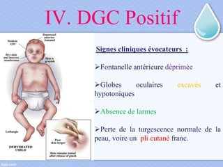 IV. DGC Positif
Signes cliniques évocateurs :
Fontanelle antérieure déprimée
Globes oculaires excavés et
hypotoniques
Absence de larmes
Perte de la turgescence normale de la
peau, voire un pli cutané franc.
 