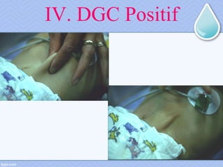 IV. DGC Positif
 