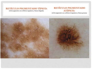 RETÍCULO PIGMENTADO TÍPICO:
red de pigmento con orificios regulares y líneas delgadas
RETÍCULO PIGMENTADO
ATÍPICO:
red de pigmento con orificios irregulares y líneas gruesas
 