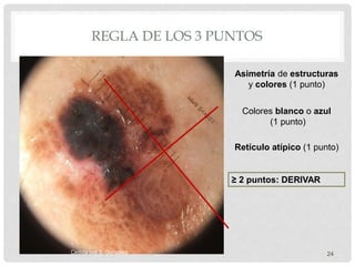 REGLA DE LOS 3 PUNTOS
24
Asimetría de estructuras
y colores (1 punto)
Colores blanco o azul
(1 punto)
Retículo atípico (1 punto)
≥ 2 puntos: DERIVAR
Cedida por S. González
 