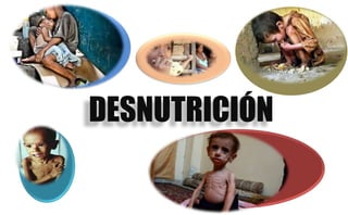 DESNUTRICIÓN
 