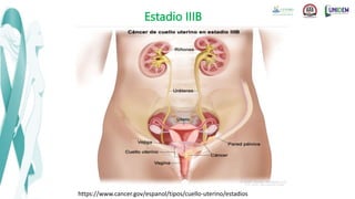 Estadio IIIB
https://www.cancer.gov/espanol/tipos/cuello-uterino/estadios
 