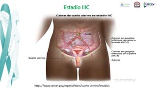 Estadio IIIC
https://www.cancer.gov/espanol/tipos/cuello-uterino/estadios
 