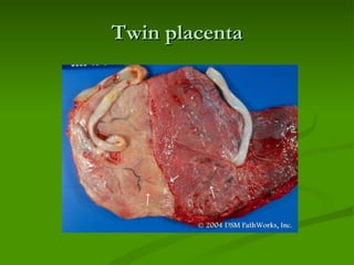 Twin placenta 