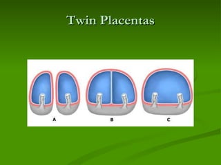 Twin Placentas 