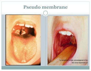 Pseudo membrane
 